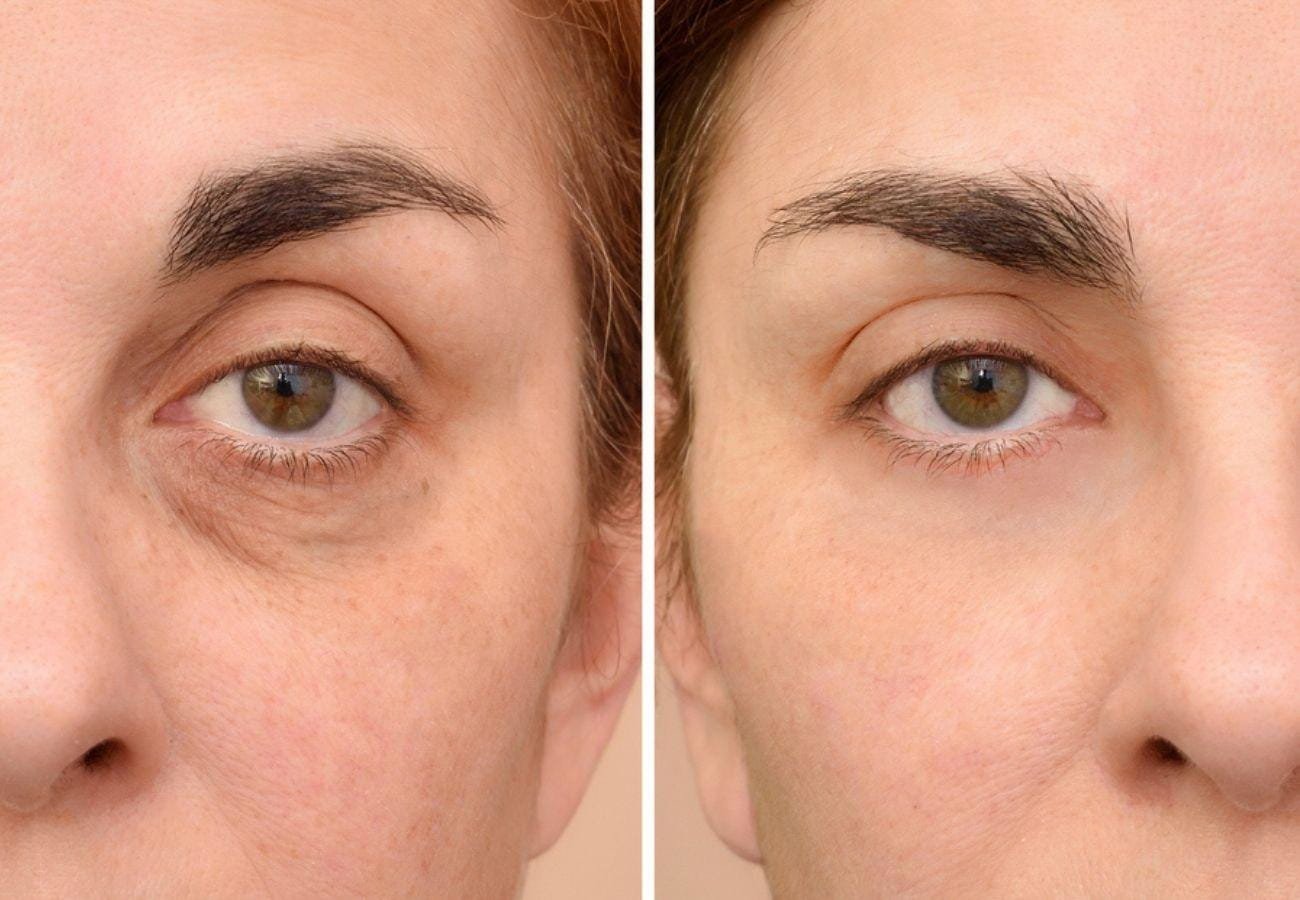 Contorno de Ojos para Ojeras Oscuras: Guía de los Mejores Despigmentantes.